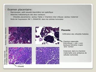 Tumeur rhabdoïde congénitale disséminée et atteinte placentaire: à propos d’un cas.