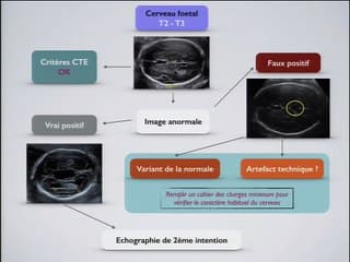 Cerveau foetal : Reconnaître les variantes de la normale de découverte imprévue ?