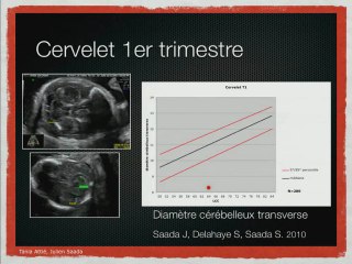 ANOMALIES DU TUBE NEURAL Encéphalocele, exencéphalie et autres anomalies hautes du tube neural.