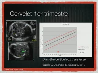 ANOMALIES DU TUBE NEURAL Encéphalocele, exencéphalie et autres anomalies hautes du tube neural.