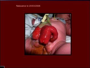 Syndrome OEIS