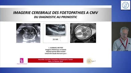 Signes échographiques du CMV ; vers une autre classification