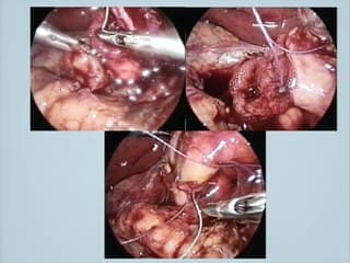 Coincer la bulle : parce qu’il n’y a pas que l’atrésie duodénale.