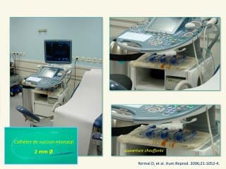 Utérus : les tumeurs endométrialeset leur classification