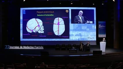 CRANIOSTÉNOSE • Dépistage anténatal