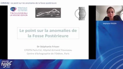Le point sur les anomalies de la fosse postérieure