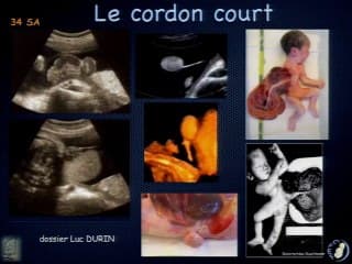 Quand le cordon est coupable......