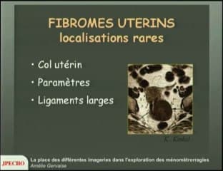 La place des différentes imageries (échographie, hystéro-sonographie, IRM) dans l’exploration des ménométrorragies