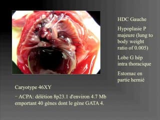Anasarque et HDC : diagnostic difficile