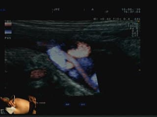 Live Doppler utérin