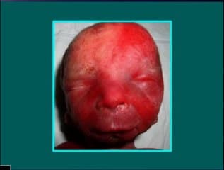 Syndrome de Franceschetti (dysostose mandibulo-faciale)