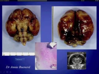Le cerveau : de la mesure au diagnostic Micro/macrocéphalie