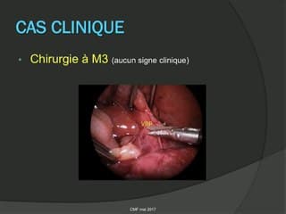 Une image en double bulle n’est pas toujours une atrésie duodénale.