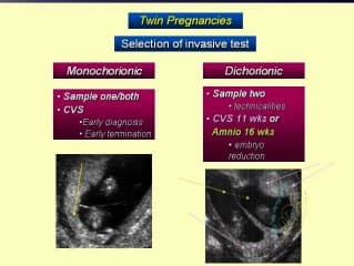 Dépistage des anomalies chromosomiques : grossesses multiples