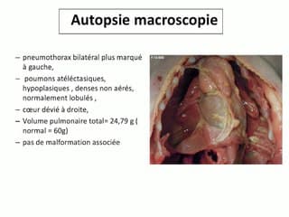 Récidive d’hypoplasie pulmonaire primitive par dysplasie acineuse : discussion autour de l’accompagnement à la naissance.