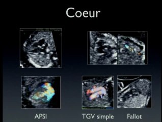 Morphologie foetale au premier trimestre : où s’arrêteront-ils ?