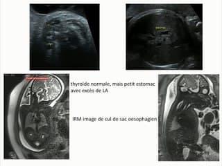 57 Hydramnios et la thyroïde ?