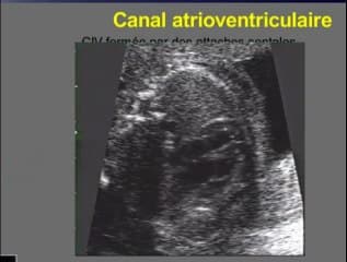 Le CAV : canal atrioventriculaire. Ce qu’il faut retenir