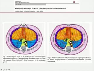 Hernie diaphragmatique : diagnostic et paramêtres anténatals de pronostic