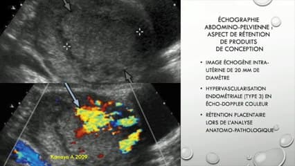 ÉCHOGRAPHIE EN SALLE DE TRAVAIL Échographie et hémorragie du post-partum