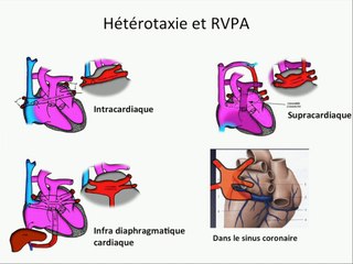 L’hétérotaxie dans tous ses états.
