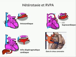 L’hétérotaxie dans tous ses états.