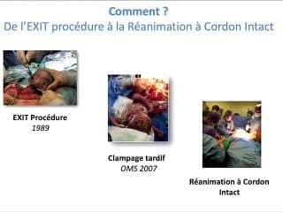 Réanimation à Cordon Intact chez les nouveau-nés porteurs d’une hernie diaphragmatique.