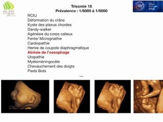 TUBE DIGESTIF  Associations syndromiques : comment s’y retrouver ?