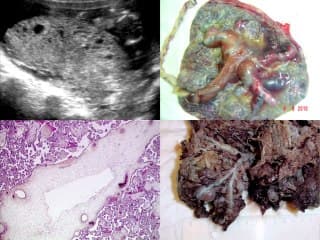Dysplasie mésenchymateuse du placenta : a propos de 15  cas