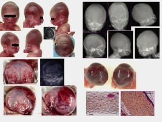 Une anomalie osseuse syndromique.