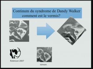 irm de la fosse posterieure