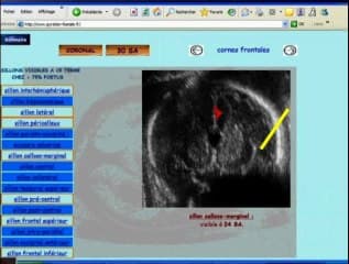 Gyration du cerveau fœtal normal