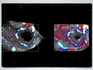 Masses ovariennes découvertes au 1er trimestre de la grossesse