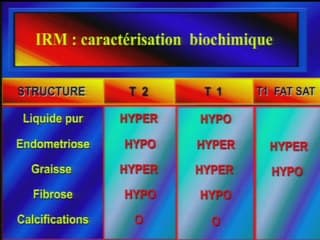 Classer les tumeurs de l'ovaire Apport de l'IRM