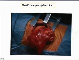 Pathologies pulmonaires : définitions - anatomopathologie