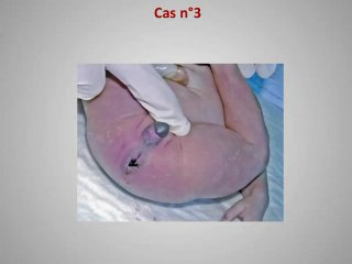 hematocolpos