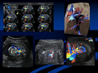 Diagnostic échographique anténatal des volvulus du grêle. Apport de l’IRM fœtale.