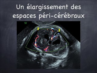 Zika : Microcéphalie et pas que …