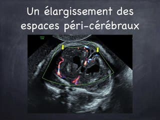 Zika : Microcéphalie et pas que …