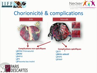 PAG et RCIU Spécificités de l'examen échographique en cas de RCIU chez des jumeaux