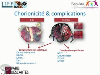 PAG et RCIU Spécificités de l'examen échographique en cas de RCIU chez des jumeaux