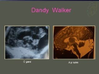 Grande image liquidienne de la fosse postérieure : éléments échographiques orientant l’étiologie