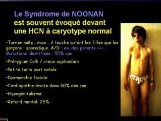 Clarté nucale à caryotype normal : le point de vue du pédiatre