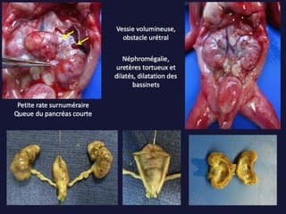 Déficit héréditaire en GPI : description de 3 cas fœtaux