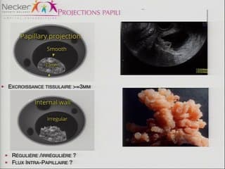 Classer les tumeurs de l'ovaire Sémiologie échographique et rédaction du compte rendu en première intention