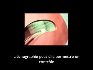 Le transfert embryonnaire échoguidé  Contre :