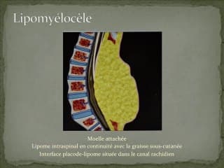 Pieds bots... signe d'appel d'un dysraphisme ?