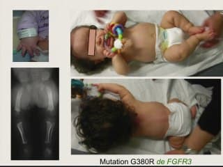 Devenir des anomalies de croissance et ostéochondrodysplasie.