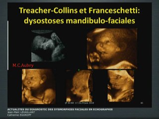 Actualités du diagnostic des dysmorphies faciales en échographie
