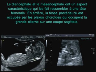échographie  du cerveau au 1 er trim